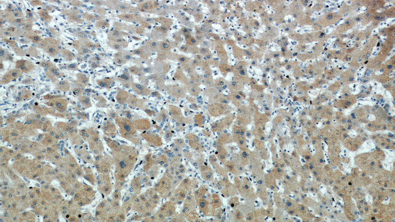 Immunohistochemical of paraffin-embedded human hepatocirrhosis using Catalog No:113641(PDXDC1 antibody) at dilution of 1:100 (under 10x lens)