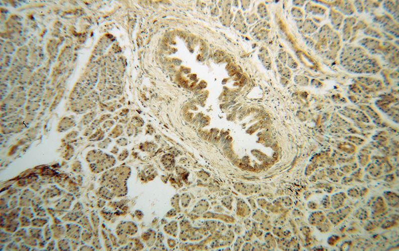 Immunohistochemical of paraffin-embedded human pancreas cancer using Catalog No:112832(MRPL48 antibody) at dilution of 1:50 (under 10x lens)