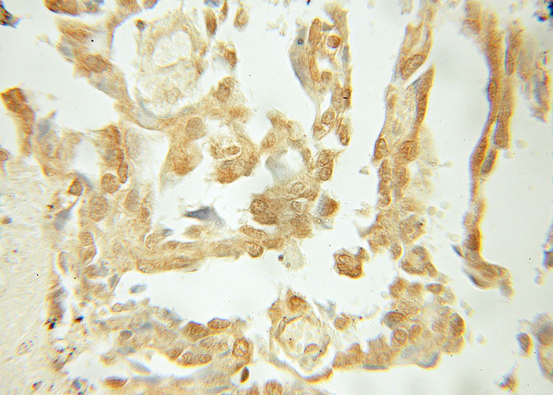 Immunohistochemical of paraffin-embedded human lung cancer using Catalog No:108387(BCL10 antibody) at dilution of 1:50 (under 40x lens)