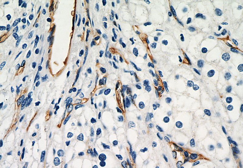Immunohistochemistry of paraffin-embedded human renal cell carcinoma tissue slide using Catalog No:107918(AGER Antibody) at dilution of 1:200 (under 40x lens).
