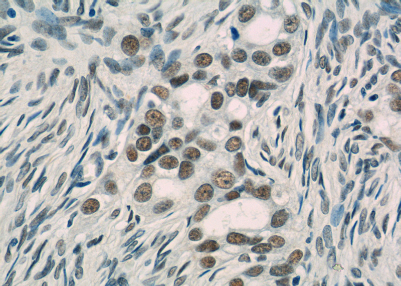 Immunohistochemistry of paraffin-embedded human ovary tumor tissue slide using Catalog No:116012(GTF2I Antibody) at dilution of 1:50 (under 40x lens)