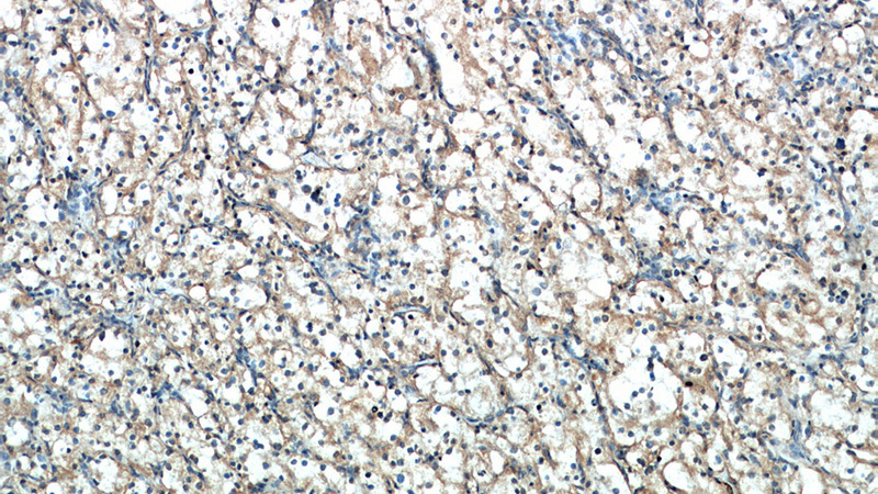 Immunohistochemical of paraffin-embedded human renal cell carcinoma using Catalog No:117251(ZNF839 antibody) at dilution of 1:50 (under 10x lens)