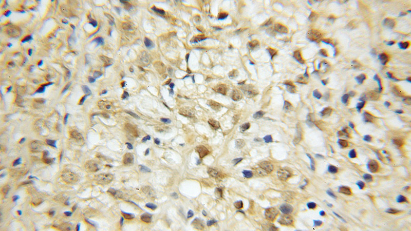 Immunohistochemical of paraffin-embedded human prostate cancer using Catalog No:111400(HELLS antibody) at dilution of 1:100 (under 10x lens)