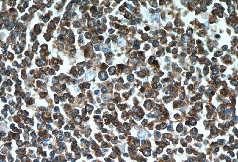 Immunohistochemical of paraffin-embedded human tonsillitis using Catalog No:115269(SHCBP1 antibody) at dilution of 1:50 (under 40x lens)