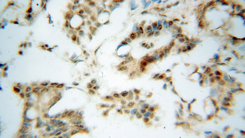 Immunohistochemical of paraffin-embedded human ovary tumor using Catalog No:117228(BRD3 antibody) at dilution of 1:50 (under 40x lens)
