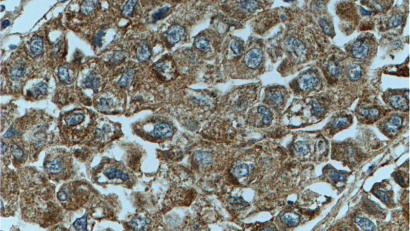 Immunohistochemistry of paraffin-embedded human liver cancer tissue slide using Catalog No:114059(PON2 Antibody) at dilution of 1:200 (under 40x lens)