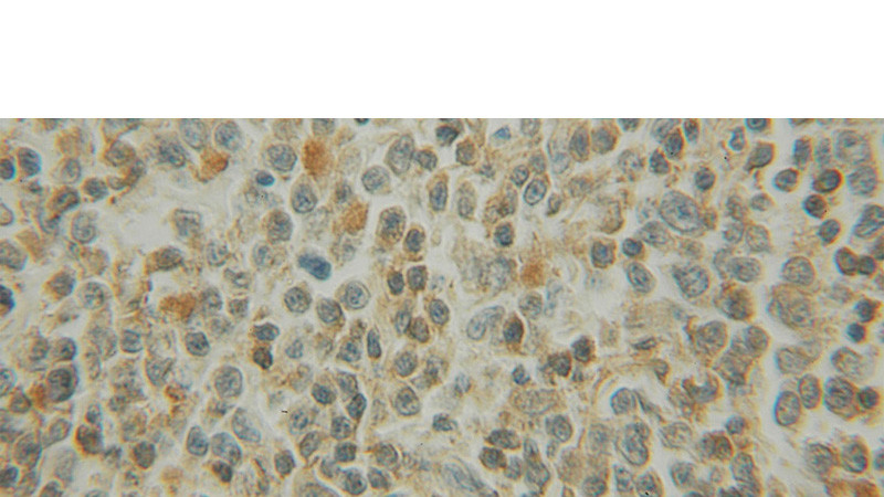 Immunohistochemical of paraffin-embedded human lymphoma using Catalog No:110506(EXOSC1 antibody) at dilution of 1:100 (under 10x lens)
