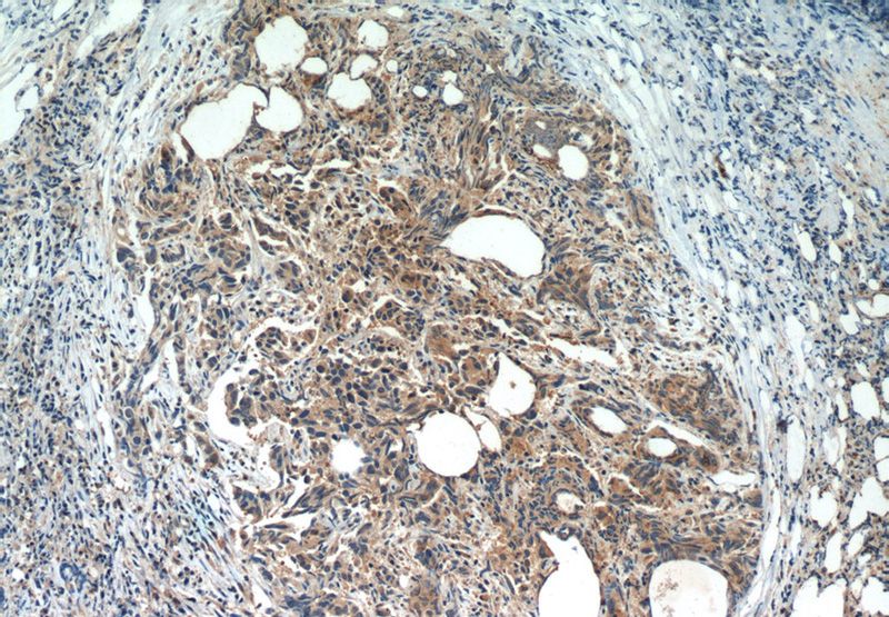 Immunohistochemistry of paraffin-embedded human prostate cancer slide using Catalog No:115832(SULT2B1 Antibody) at dilution of 1:50. Heat mediated antigen retrieved with Citric acid buffer, pH6.0.