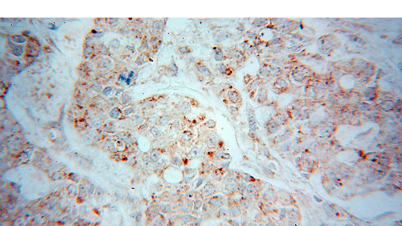 Immunohistochemical of paraffin-embedded human breast cancer using Catalog No:112846(MRPS18B antibody) at dilution of 1:50 (under 40x lens)