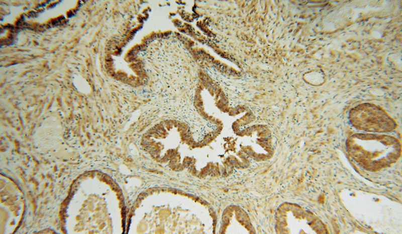 Immunohistochemical of paraffin-embedded human gliomas using Catalog No:116270(TMOD2 antibody) at dilution of 1:100 (under 10x lens)