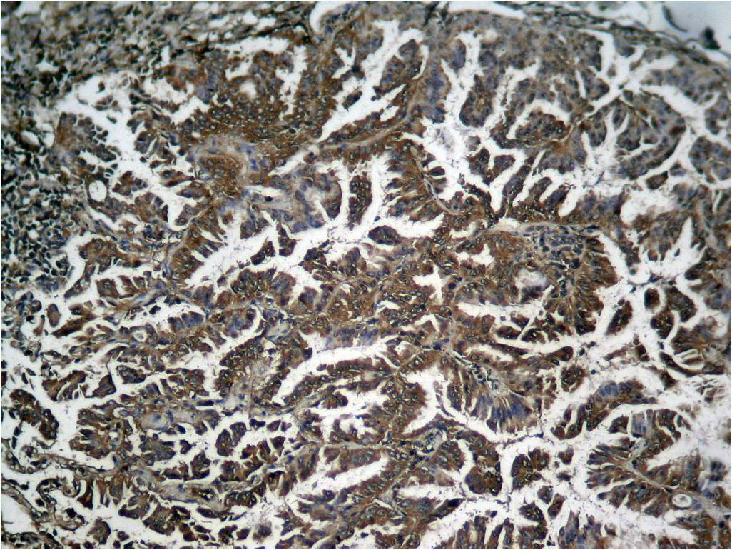 Immunohistochemical analysis of paraffin-embedded human Lung carcinoma tissue using NF-κB p65 (Phospho-Ser536) Antibody .