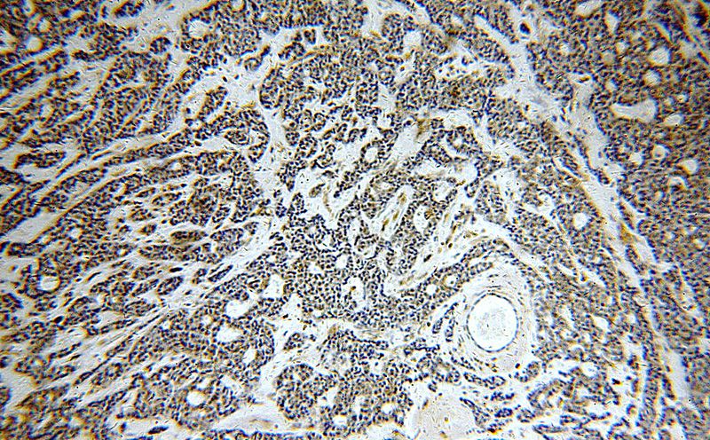 Immunohistochemical of paraffin-embedded human cervical cancer using Catalog No:108274(C12orf11 antibody) at dilution of 1:100 (under 10x lens)