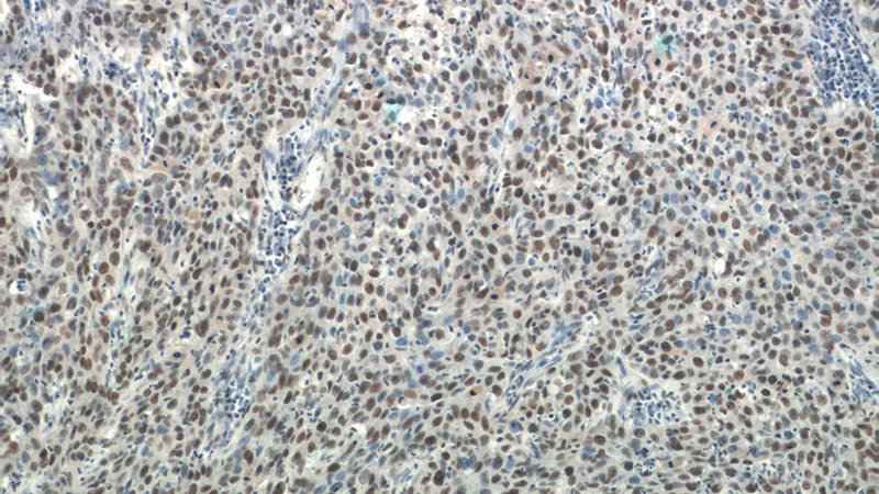 Immunohistochemistry of paraffin-embedded human cervical cancer tissue slide using Catalog No:115458(SNRPB Antibody) at dilution of 1:50 (under 10x lens)