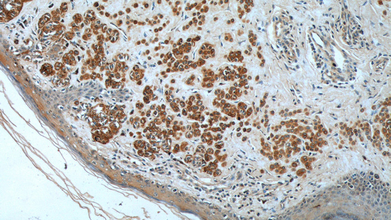 Immunohistochemistry of paraffin-embedded human malignant melanoma tissue slide using Catalog No:107426(MLANA Antibody) at dilution of 1:200 (under 10x lens).