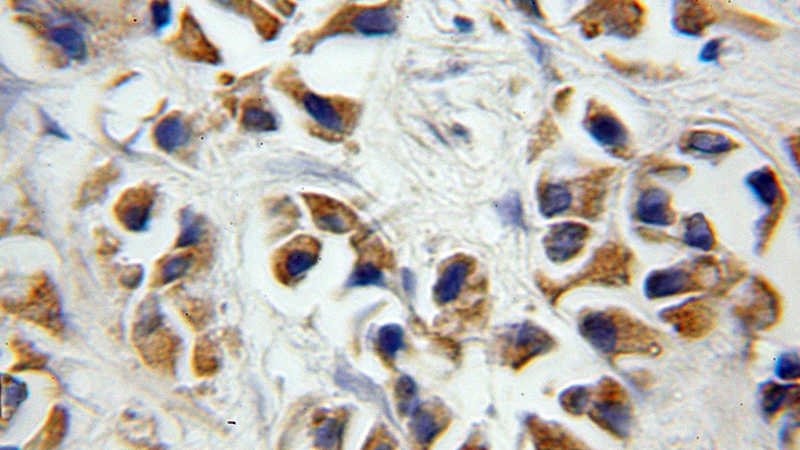 Immunohistochemical of paraffin-embedded human prostate cancer using Catalog No:113544(P2RX7 antibody) at dilution of 1:50 (under 10x lens)