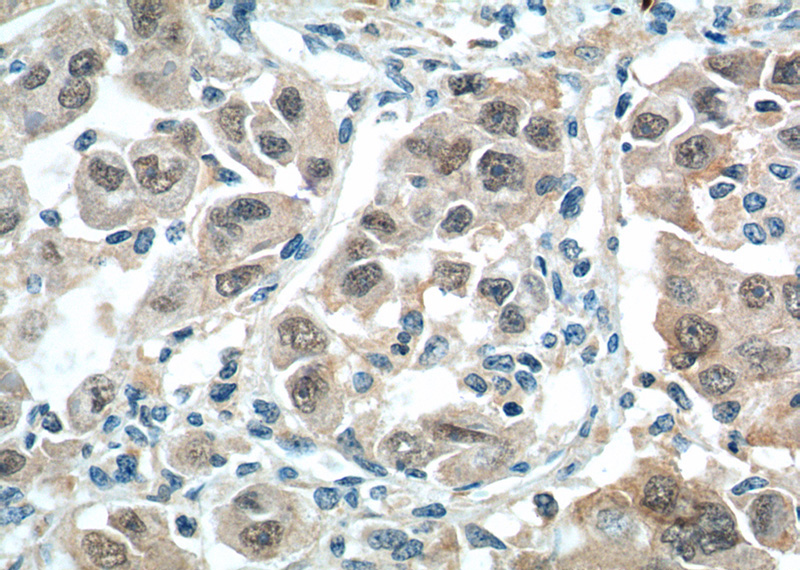Immunohistochemistry of paraffin-embedded human liver cancer tissue slide using Catalog No:117104(BCL9 Antibody) at dilution of 1:200 (under 40x lens).