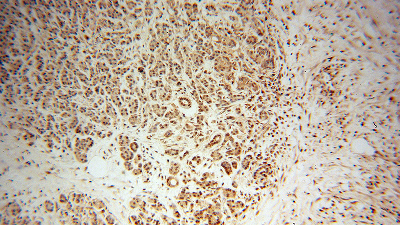 Immunohistochemical of paraffin-embedded human pancreas cancer using Catalog No:114565(RBPJ antibody) at dilution of 1:100 (under 10x lens)