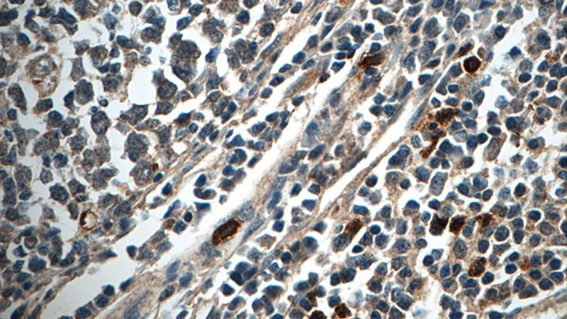 Immunohistochemistry of paraffin-embedded human tonsillitis tissue slide using Catalog No:107388(IL1F8 Antibody) at dilution of 1:50 (under 40x lens)