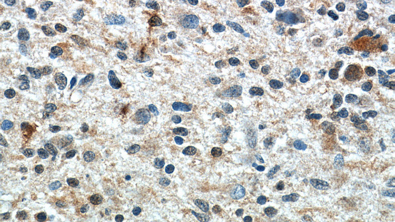 Immunohistochemistry of paraffin-embedded human gliomas slide using Catalog No:116648(UBQLN1 Antibody) at dilution of 1:50