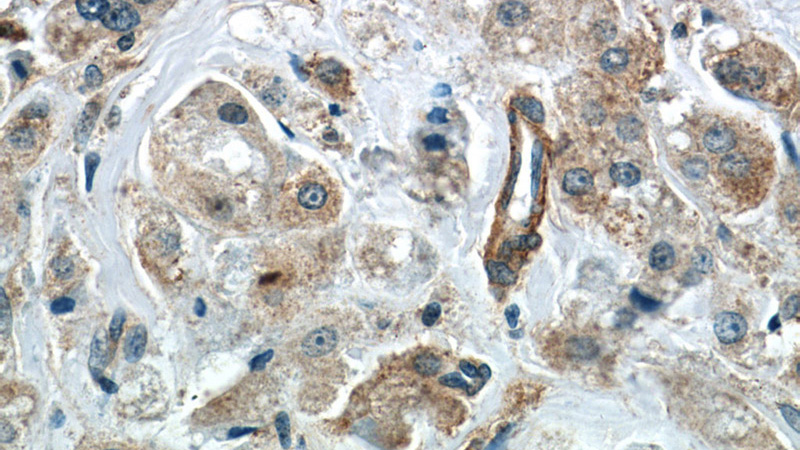Immunohistochemistry of paraffin-embedded human breast cancer slide using Catalog No:108994(CCDC99 Antibody) at dilution of 1:50 (under 40x lens)