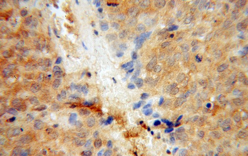 Immunohistochemical of paraffin-embedded human skin cancer using Catalog No:114899(RPL7 antibody) at dilution of 1:100 (under 40x lens)