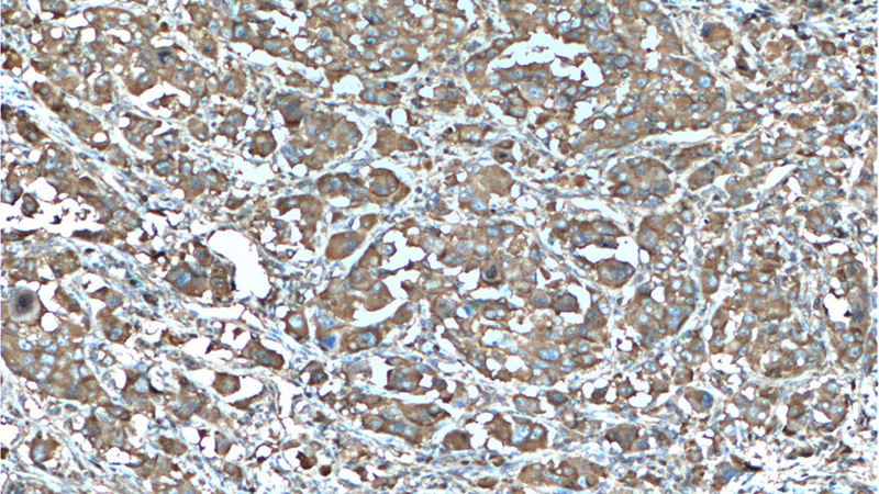 Immunohistochemistry of paraffin-embedded human liver cancer tissue slide using Catalog No:107571(ALDoc Antibody) at dilution of 1:200 (under 10x lens). heat mediated antigen retrieved with Tris-EDTA buffer(pH9).