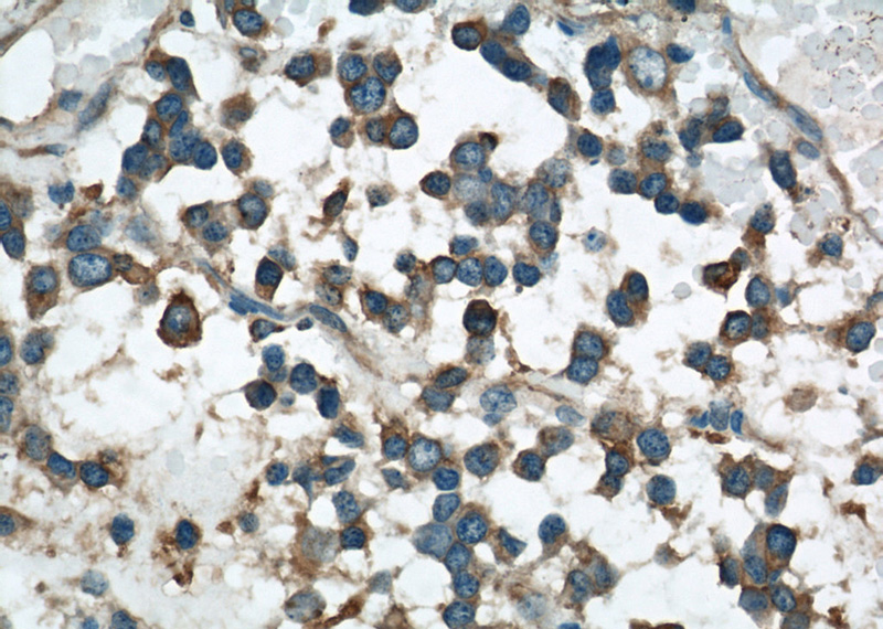 Immunohistochemical of paraffin-embedded human gliomas using Catalog No:116720(VAT1 antibody) at dilution of 1:50 (under 40x lens)