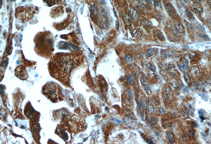 Immunohistochemistry of paraffin-embedded human lung cancer tissue slide using Catalog No:111378(HDAC4-specific Antibody) at dilution of 1:50 (under 40x lens)