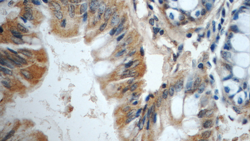Immunohistochemistry of paraffin-embedded human colon tissue slide using Catalog No:110639(FGFBP3 Antibody) at dilution of 1:50 (under 40x lens)