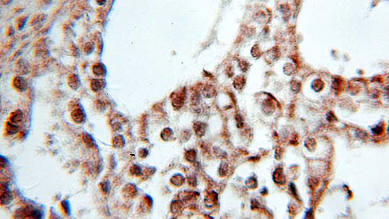Immunohistochemical of paraffin-embedded human ovary tumor using Catalog No:114084(PPARD antibody) at dilution of 1:10 (under 10x lens)