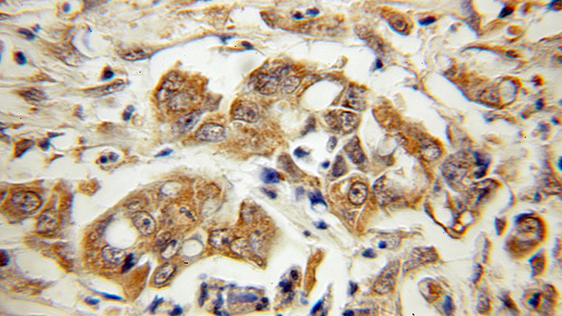 Immunohistochemical of paraffin-embedded human colon cancer using Catalog No:114718(PEBP1 antibody) at dilution of 1:10 (under 10x lens)