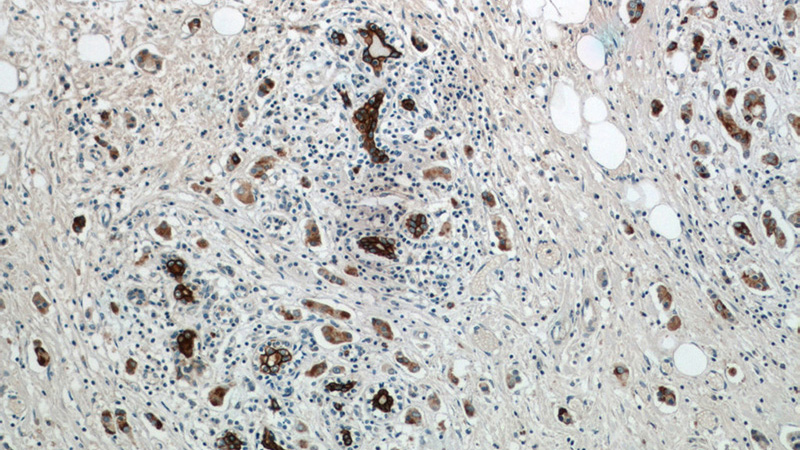 Immunohistochemistry of paraffin-embedded human breast cancer tissue slide using Catalog No:109342(Claudin 4-specific Antibody) at dilution of 1:50 (under 10x lens)