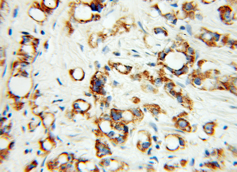 Immunohistochemical of paraffin-embedded human prostate cancer using Catalog No:110567(FCER1A antibody) at dilution of 1:100 (under 10x lens)