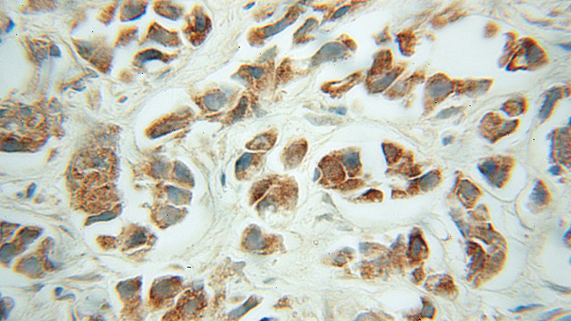 Immunohistochemical of paraffin-embedded human prostate cancer using Catalog No:110646(FH antibody) at dilution of 1:50 (under 40x lens)