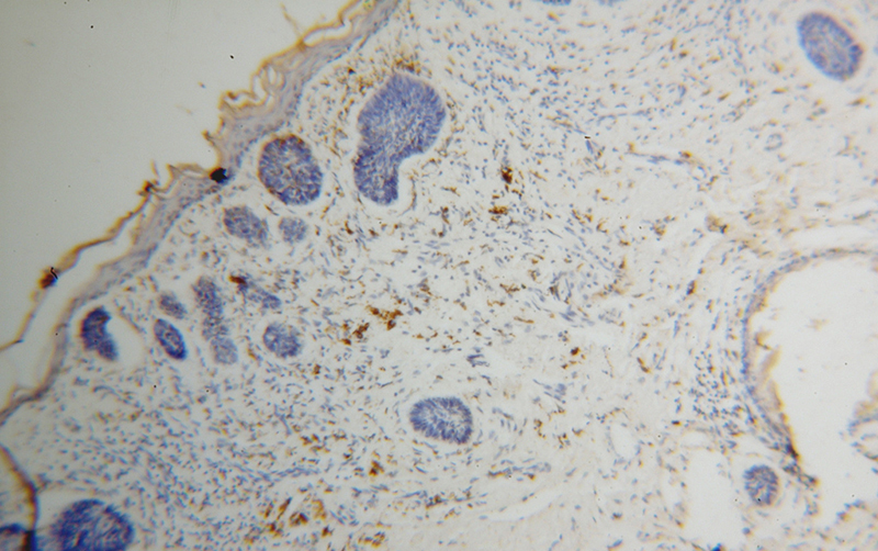 Immunohistochemical of paraffin-embedded human skin cancer using Catalog No:112820(MRPL27 antibody) at dilution of 1:50 (under 10x lens)