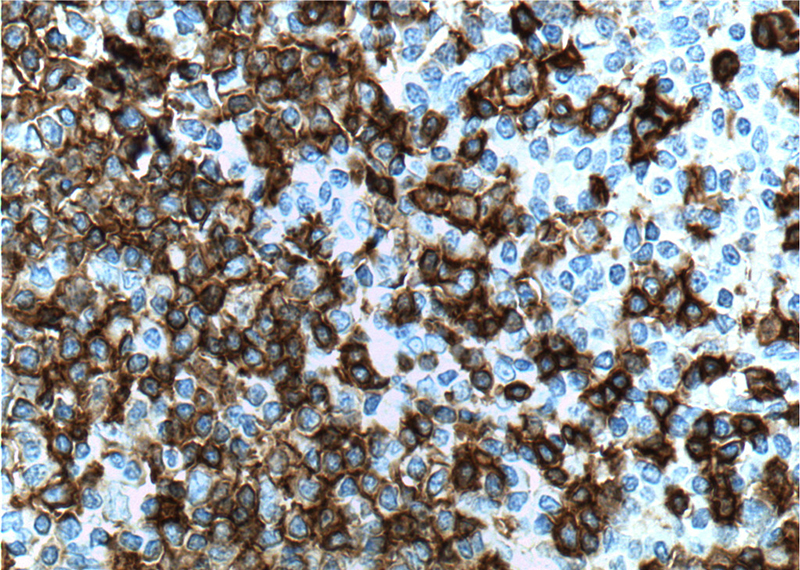 Immunohistochemistry of paraffin-embedded human tonsillitis tissue slide using Catalog No:107050(MS4A1,CD20 Antibody) at dilution of 1:200 (under 40x lens). heat mediated antigen retrieved with Tris-EDTA buffer(pH9).
