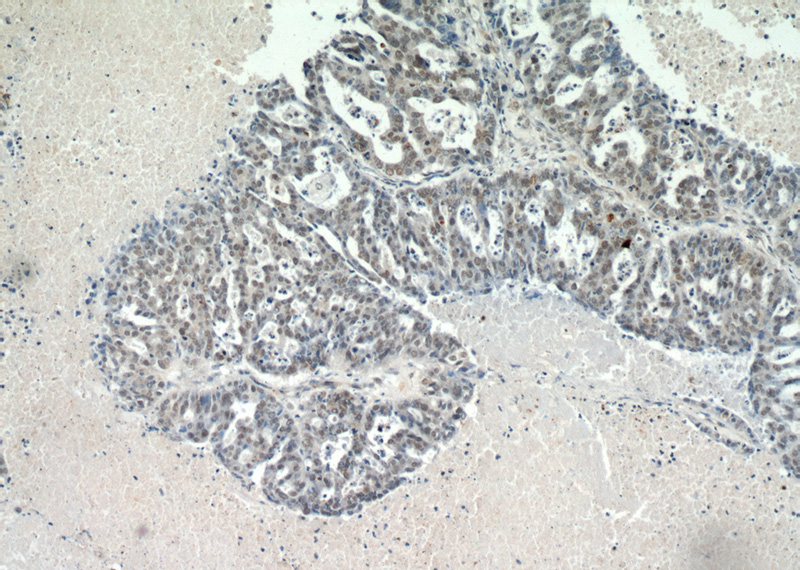 Immunohistochemical of paraffin-embedded human ovary tumor using Catalog No:109731(CTR9 antibody) at dilution of 1:50 (under 10x lens)