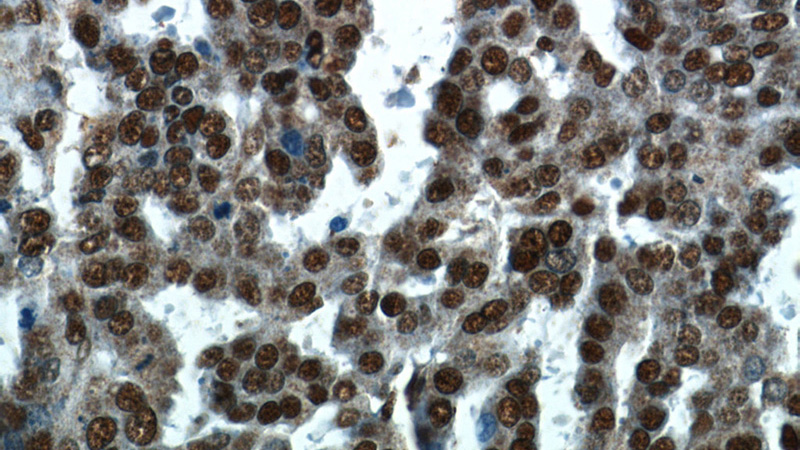 Immunohistochemistry of paraffin-embedded human ovary tumor tissue slide using Catalog No:110556(FBXO5 Antibody) at dilution of 1:50