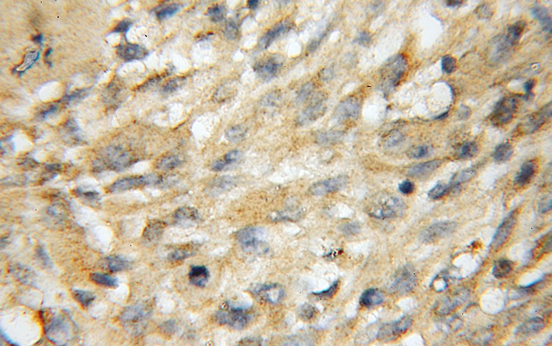Immunohistochemical of paraffin-embedded human gliomas using Catalog No:108841(CADPS antibody) at dilution of 1:50 (under 40x lens)