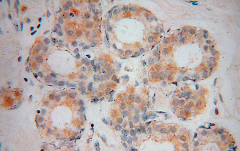 Immunohistochemical of paraffin-embedded human breast cancer using Catalog No:116776(VPS25 antibody) at dilution of 1:50 (under 40x lens)