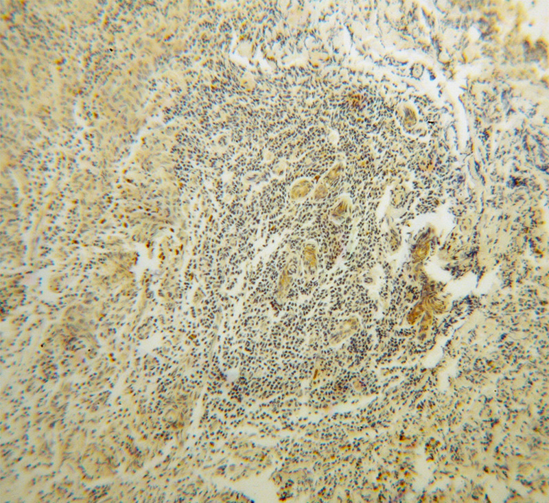 Immunohistochemical of paraffin-embedded human breast cancer using Catalog No:114893(RPL37A antibody) at dilution of 1:100 (under 10x lens)