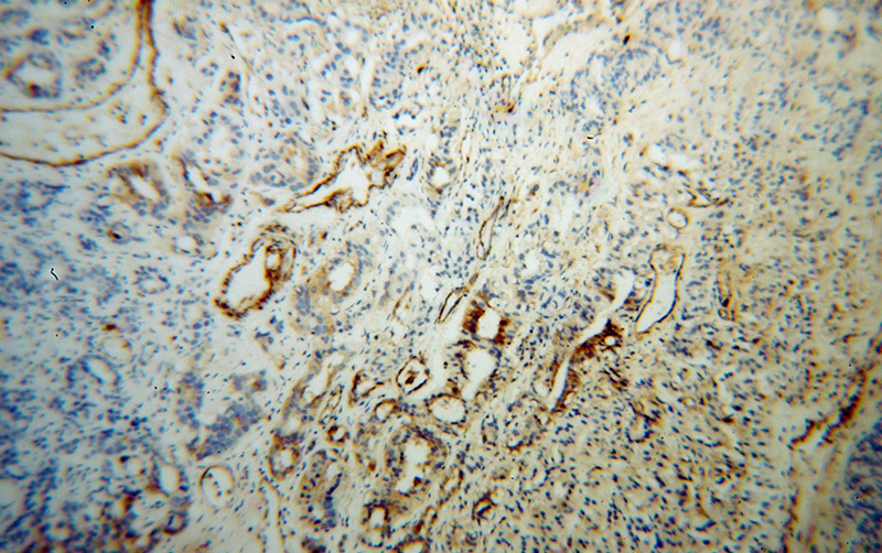 Immunohistochemical of paraffin-embedded human gliomas using Catalog No:109875(DBC1 antibody) at dilution of 1:50 (under 10x lens)