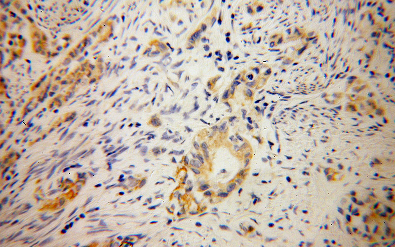 Immunohistochemical of paraffin-embedded human endometrial cancer using Catalog No:107610(STOML2 antibody) at dilution of 1:100 (under 40x lens)