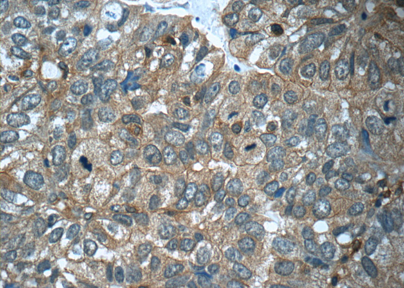 Immunohistochemistry of paraffin-embedded human breast cancer tissue slide using Catalog No:109201(CFTR Antibody) at dilution of 1:50 (under 40x lens)