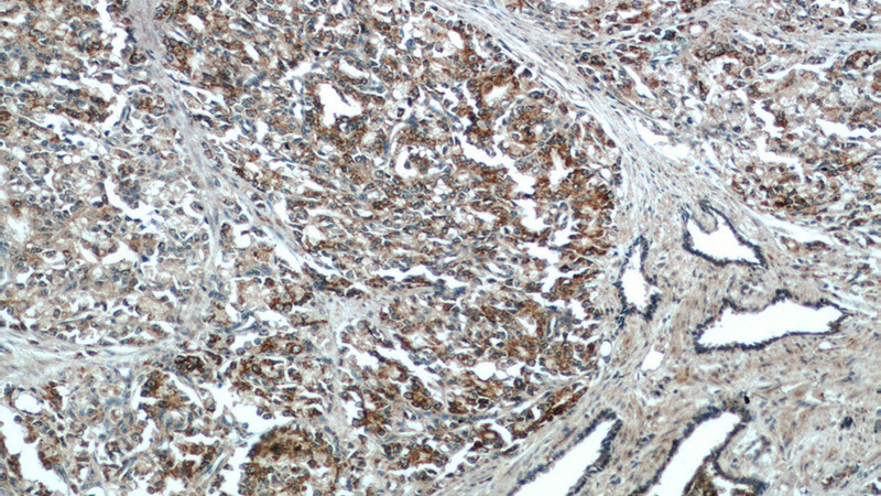 Immunohistochemistry of paraffin-embedded human prostate cancer tissue slide using Catalog No:108110(C5orf39 Antibody) at dilution of 1:50 (under 10x lens)