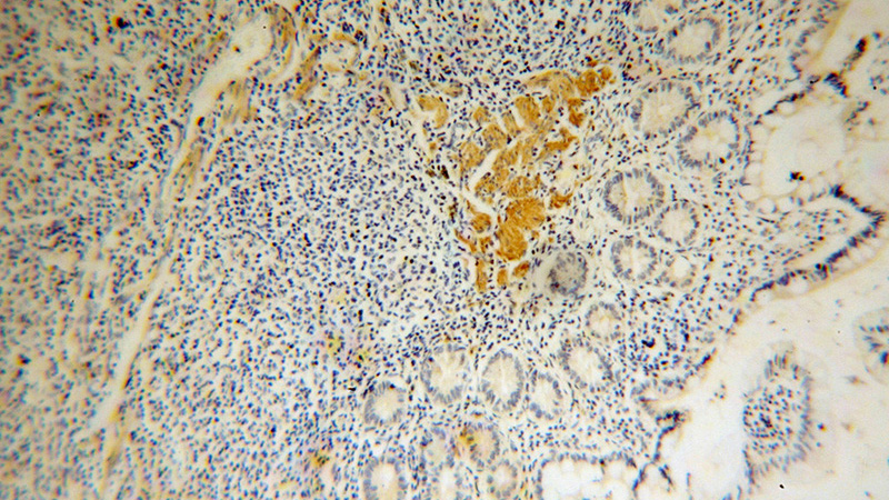 Immunohistochemical of paraffin-embedded human colon cancer using Catalog No:116395(TRMT1 antibody) at dilution of 1:50 (under 10x lens)