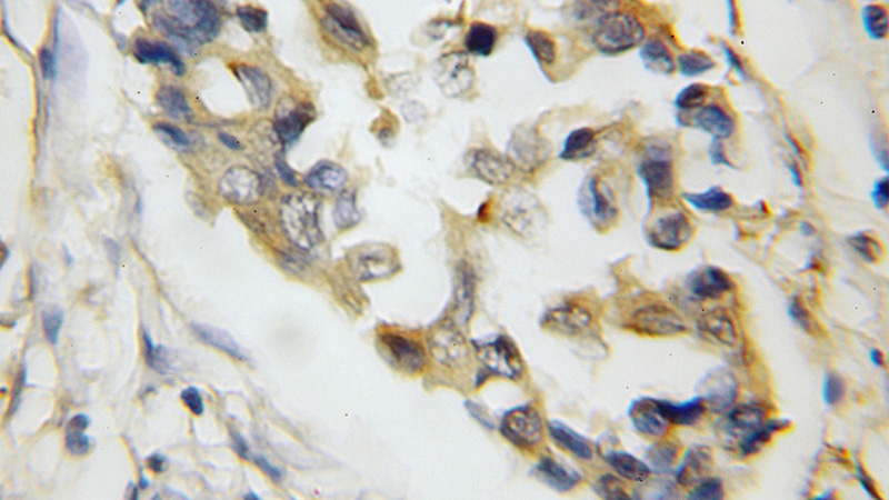 Immunohistochemical of paraffin-embedded human breast cancer using Catalog No:115962(SYTL4 antibody) at dilution of 1:50 (under 10x lens)
