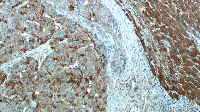 Immunohistochemical of paraffin-embedded human liver cancer using Catalog No:116397(TRMT2B antibody) at dilution of 1:50 (under 10x lens)