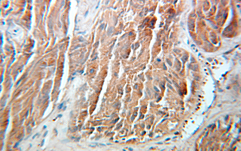 Immunohistochemical of paraffin-embedded human prostate cancer using Catalog No:115829(SULT1C2 antibody) at dilution of 1:100 (under 25x lens)