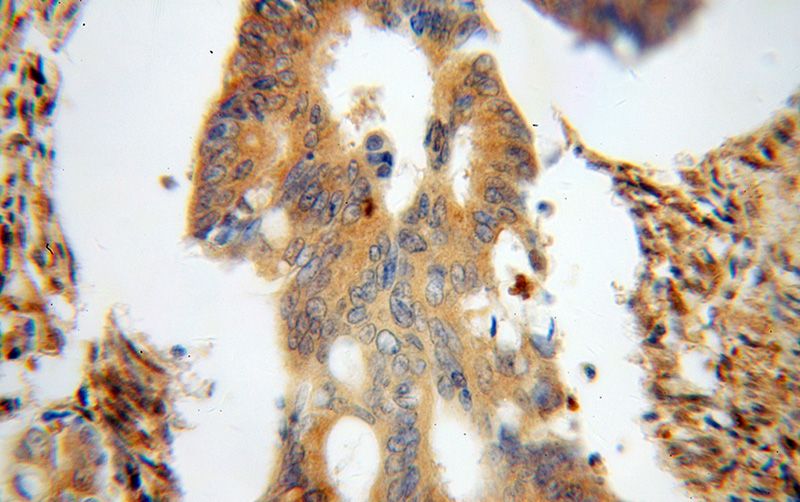 Immunohistochemical of paraffin-embedded human colon cancer using Catalog No:117186(BLMH antibody) at dilution of 1:100 (under 40x lens)